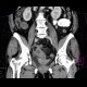 Sigmoid adenocarcinoma, peritoneal metastasis: CT - Computed tomography